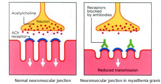 Miastenia gravis O sistema imune produz anticorpos que atacam os receptores da acetilcolina no músculo, na junção neuromuscular.