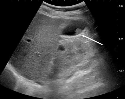 DESCARTAR LESÃO PSEUDOMUCOSA LAMA BILIAR Wu