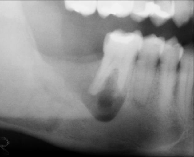 Odontogênicos associados e não a raízes