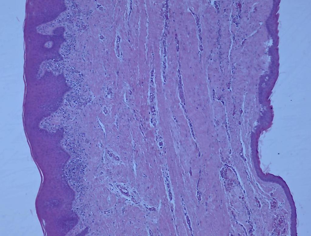 37 Figura 7 - Fotomicrografia de lesão de Ceratocisto Odontogênico exemplificando a presença de mucosa bucal na amostra de biópsia incisional para marsupialização - Coloração em Hematoxilina e