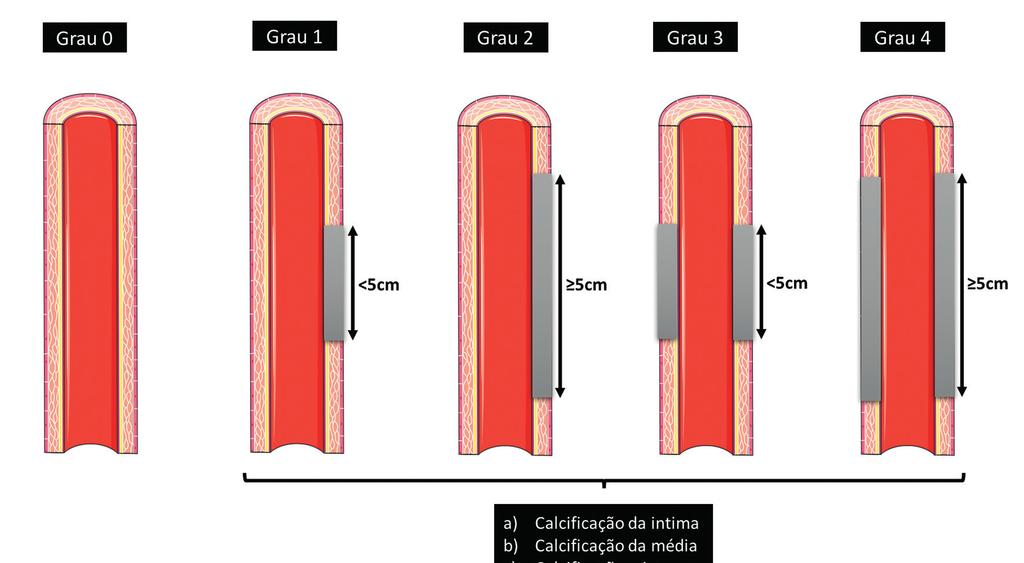 M.Neto et al. desenvolveram reestenose (> 50%) após angioplastia e/ ou stenting, em comparação com aqueles que não tiveram reestenose.