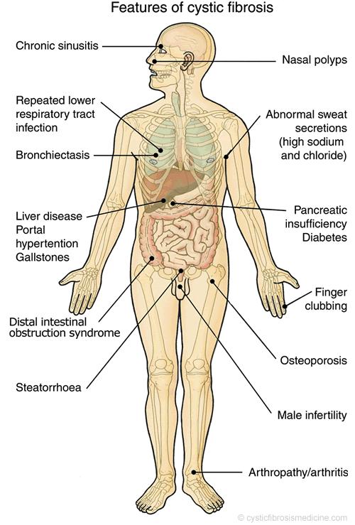 A FIBROSE CÍSTICA