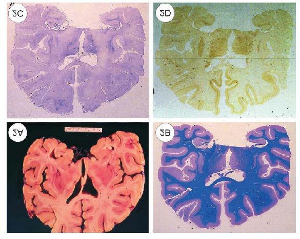 16 estruturas pa leocerebelares foram mais severamente afetadas. Observou-se também proliferação da astroglia e microglia, com degradação de mielina (fig. 6)