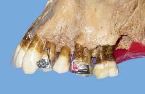 O uso de marcadores para identificação de posicionamento dentário em telerradiografias frontais póstero-anteriores: proposta de um método restritas ou nenhuma informação sobre o comportamento dos