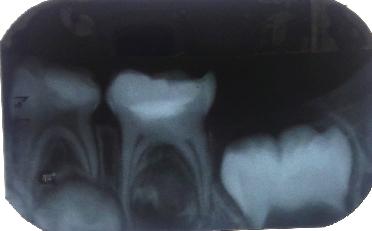 Foi observado a presença de todos os dentes decíduos e várias lesões de cáries. Um deles aparentava estar profunda, o segundo molar inferior decíduo (dente 75).