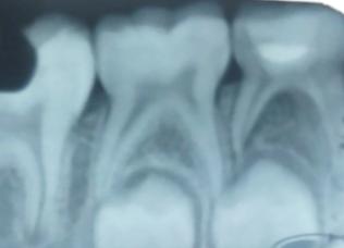 Figura 6. Radiografia do primeiro molar inferior direito decíduo após tratamento pulpar com pasta CTZ.