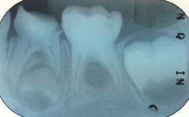 pulpar (Figura 9). Figura 9. Imagem radiográfica inicial do segundo molar inferior esquerdo decíduo.