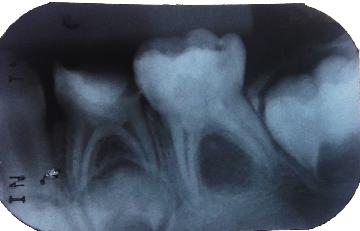 Depois de quinze dias, realizou-se apenas exame clínico do dente na qual foi observado a ausência de dor, fístula, abscesso, mobilidade dentária patológica e alteração de cor permaneceu amarelado.