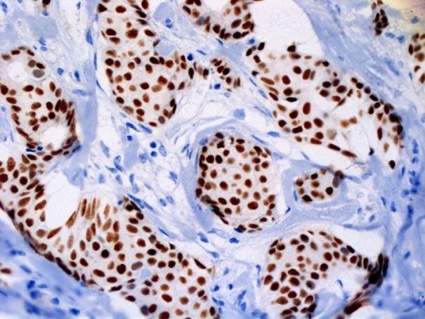 A B Figura 5 Fotomicrografias de carcinoma ductal invasivo de mama.