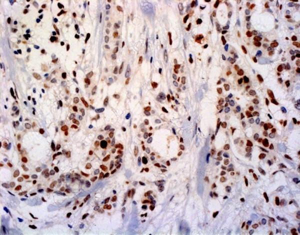 Tabela 4 - Escore utilizado na detecção da proteína EZH2 Intensidade da Porcentagem de