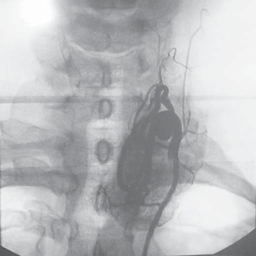 Figura 1. Angiografia da artéria tireoidiana inferior esquerda.