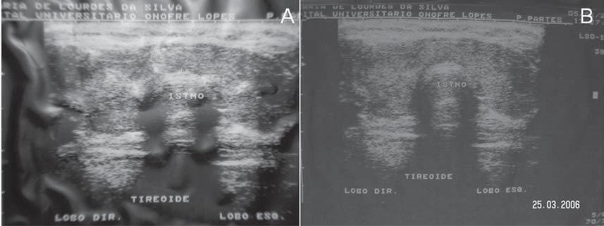 Figura 4. A: Ultrassonografia pré-embolização, com volume de 64 ml, da paciente 1. B: Ultrassonografia após 16 semanas, com volume de 16,7 ml (redução de 73,9% em relação ao volume préembolização).