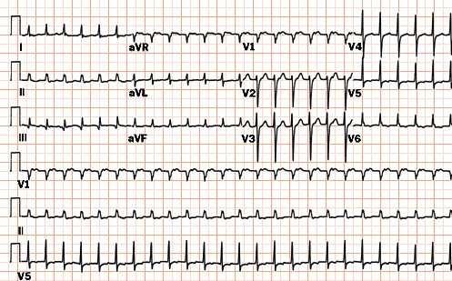 CARDIOLOGIA QUESTÃO 01 Qual traçado eletrocardiográfico representa maior gravidade? (A) Bloqueio completo do ramo direito + bloqueio divisional ântero-superior esquerdo.