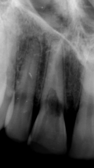 P á g i n a 35 Figura 3 Radiografia periapical com imagem