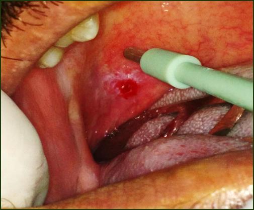 na boca que não cicatrizava havia mais de 30 dias.