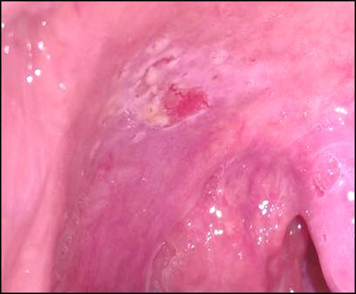 A hipótese diagnóstica inicial foi de carcinoma espinocelular por conta da histórico de tabagismo. Figura 1: Aspecto inicial da lesão.