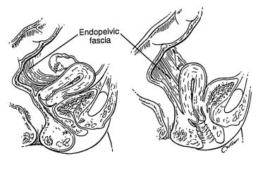 20 2.5.2.1 Nível 1 Sustenta o útero e o terço superior da vagina. É composto pela fáscia endopélvica, complexo cardinal úterossacro e porção superior do paracolpo (Girão et al., 2015).