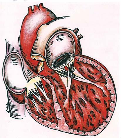 ig. 3 - Imagem ecocardiográfica pós-operatória mostrando o cruzamento dos músculos papilares. ig.