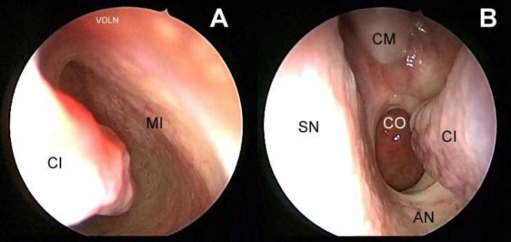 Nas endoscopias nasais, no sentido ântero-posterior podemos visualizar os cornetos inferior, médio e seus respectivos meatos (Figura 1). Figura 2: Anatomia endoscópica nasal.