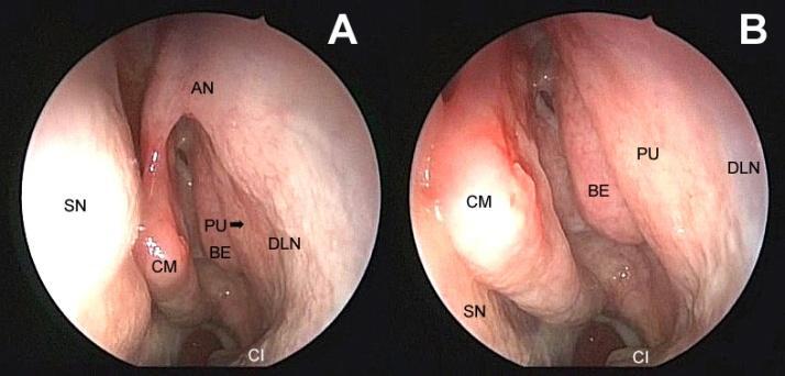 endoscopicamente os seios maxilar, frontal, etmoidal e até mesmo esfenoidal, após etmoidectomia completa 4,5,6.