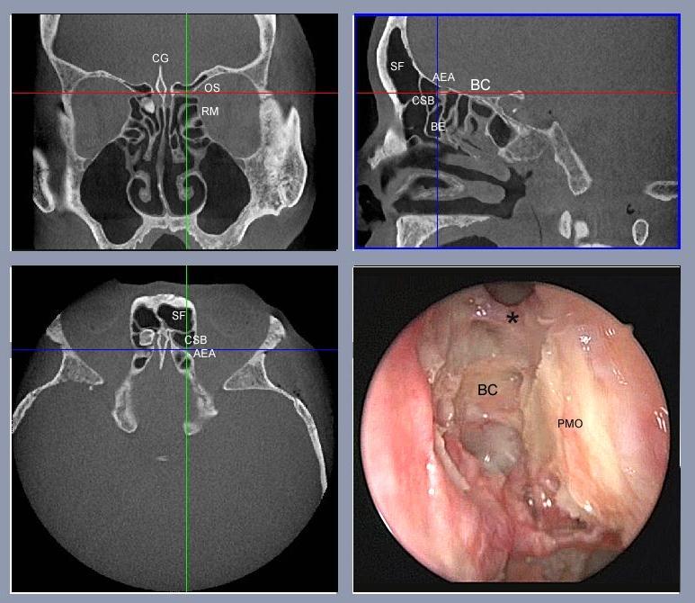 Figura 9: Tomografia computadorizada de seios paranasais evidenciando drenagem do seio frontal direito. (A): AN: ággernasi; D: drenagem do seio frontal; SF: seio frontal.