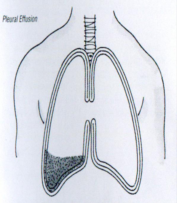 Derrame Pleural Espaço entre as pleuras: virtual Líquido pleural Função lubrificante Volume: ~ 20ml Produção