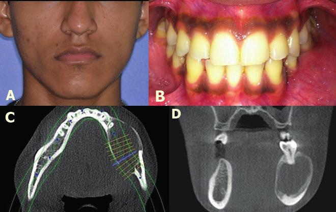 Figura 1 - Aspecto extraoral com leve assimetria facial do lado esquerdo (A) e vista intraoral mostrando aumento de volume em região posterior esquerda da mandíbula (B).