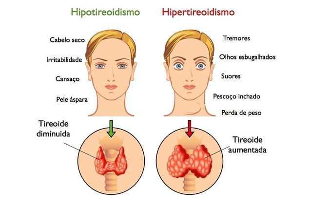 2. GLÂNDULA TIREÓIDE: Excesso de T3 e T4, HIPERTIROIDISMO: da produção de calor, de perda de peso, nervosismo,