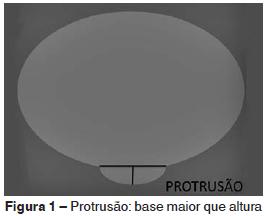 dor na distribuição radicular bilateral, Sendo que, em muitas vezes, as dores são sentidas em local distantes da herniação do disco (CECIL, 1992).