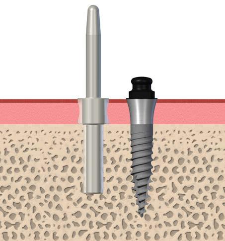 Como função secundária, ao elevar um retalho de tecido ou efetuar uma punção de tecido, o lado de 2,2 mm do pilar de paralelismo pode ser usado para medir/obter informações acerca da altura da