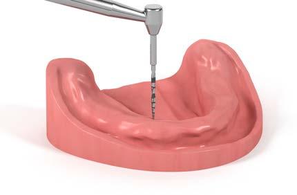 2.4 Inserção do implante Estabilização de uma prótese no maxilar inferior São necessários, no mínimo, quatro Straumann Mini Implants no maxilar inferior.