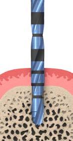 Perfure a base implantar até à profundidade final com a broca de agulha de 1,6 mm, corrigindo simultaneamente a orientação do eixo do implante, se necessário.
