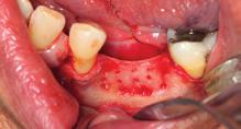 4 Checagem do retalho É crucial utilizar um retalho de forma adequada para que o fechamento seja sem tensões, complementando com incisões internas que eliminam inserções musculares 30.