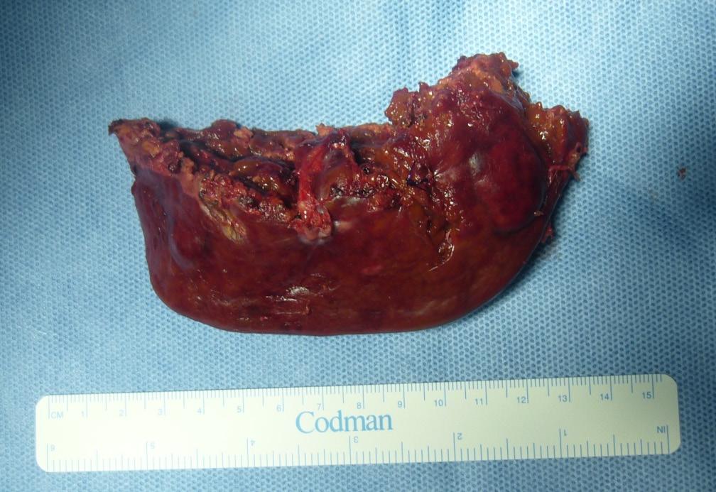 Três pacientes foram submetidos à biópsia de congelação intra-operatória, que confirmou adenoma hepático em dois casos e carcinoma hepatocelular no terceiro.