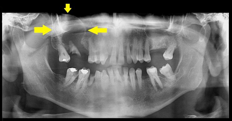 Cisto periapical associado às raízes (residuais) do elemento 17 e que se projeta para o interior do seio maxilar correspondente, com expressivo aumento de volume da cortical de seu assoalho.