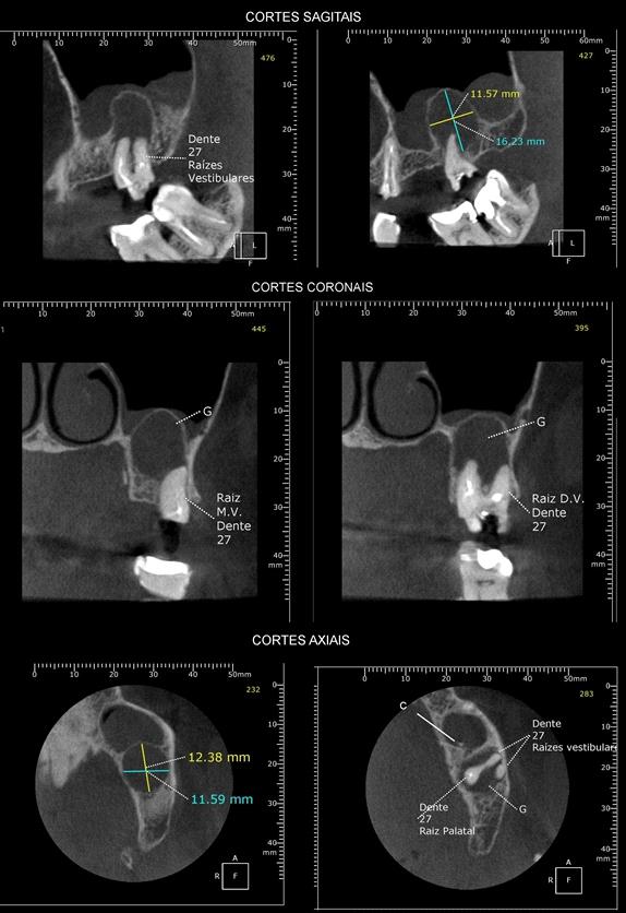 Cisto periapical (G), associado às raízes do dente 27 (com respectivos condutos parcialmente