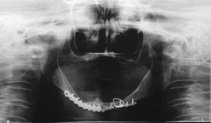 A tomografia computadorizada (TC) solicitada pela equipe demonstrou alteração posicionamento condilar e torção no côndilo mandibular direito (Figuras 3 e 4).