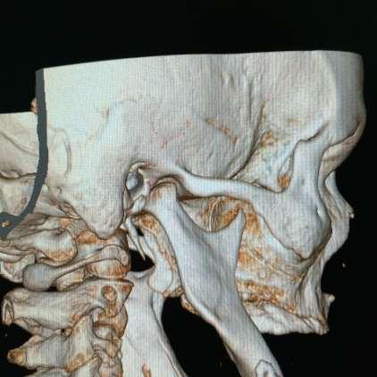 articulações temporomandibulares (ATM) e desvio acentuado da mandíbula para o lado direito após uma cirurgia para redução e fixação de uma fratura mandibular em outro serviço (Figura 1).
