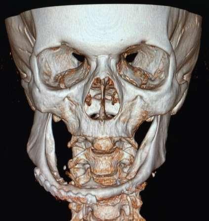 A paciente apresentava uma radiografia panorâmica realizada após o procedimento cirúrgico onde se observou uma mandíbula atrófica classe III de Luhr 4 fixada em ambos os lados com: uma placa de