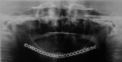 A radiografia panorâmica pós-operatória de 2 meses demonstrou a reposição dos processos condilares e,