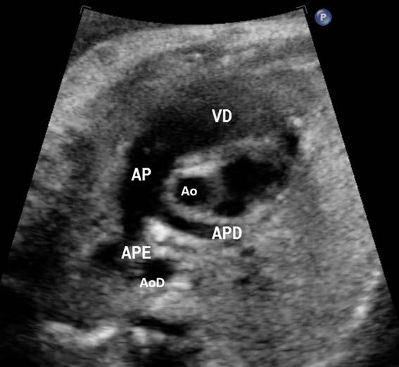 A: anterior; E: estômago; P: posterior; VD: ventrículo direito; VE: ventrículo esquerdo. Figura 2.7 Projeção eixo curto dos vasos da base.