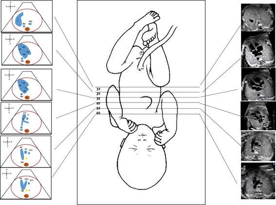 2.2. Rastreamento do Coração Fetal ao Ultrassom Morfológico Considerando todos estes aspectos, propomos uma metodologia de avaliação do coração fetal de forma muito simples, que vem sendo aplicada em