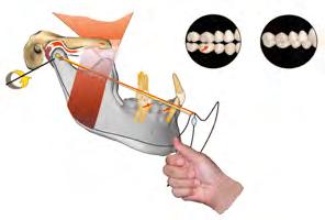 Contatos dentários dinâmicos de classe I Fig 3-2-17 Relação cêntrica: rotação da mandíbula em sua relação de rotação terminal até o ponto de contato inicial em relação cêntrica.