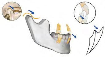 Fundamentos da oclusão classe I Fig 3-2-20 Protrusão a partir de MIC até a relação protrusiva topo a topo. A guia condilar guia posteriormente e a guia incisal guia anteriormente a mandibular.