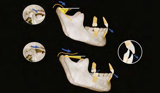 anteroposterior, plano oclusal, guia anterior, altura da cúspide e angulação da cúspide.