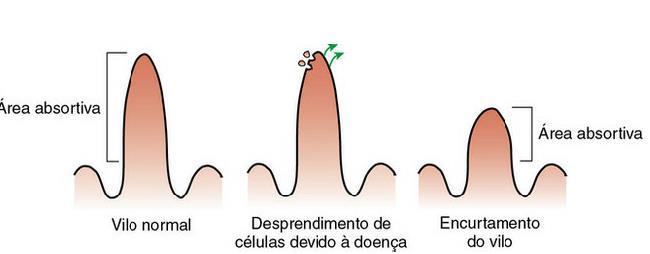 Problemas de digestão/absorção Digestão: falta de enzimas, bile Absorção danos ao epitélio absortivo