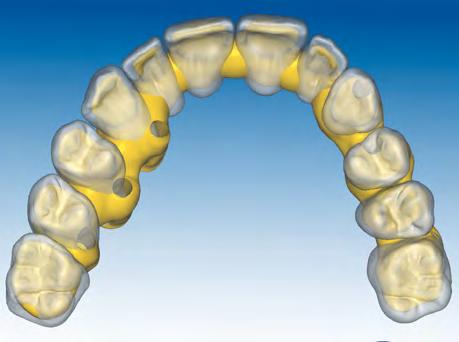 Por exemplo, em uma estratificação simples o espaço criado deverá ser suficiente para acomodar massas cerâmicas que recriam a dentina,