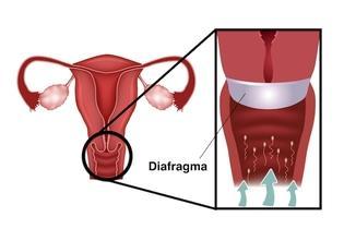 Para haver o funcionamento correto do diafragma, a mulher deve