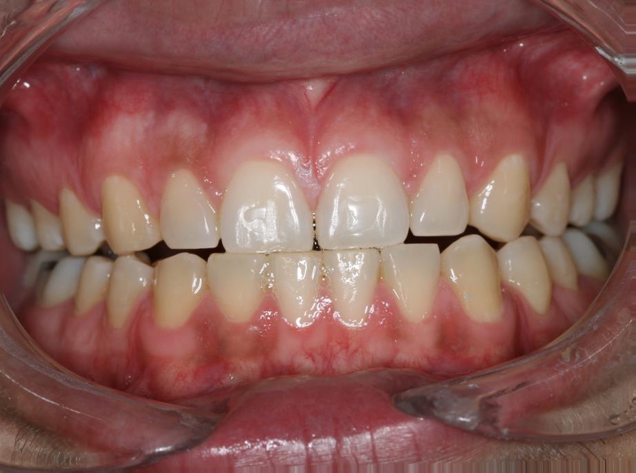 12 Figura 2- Vista intra-oral frontal inicial