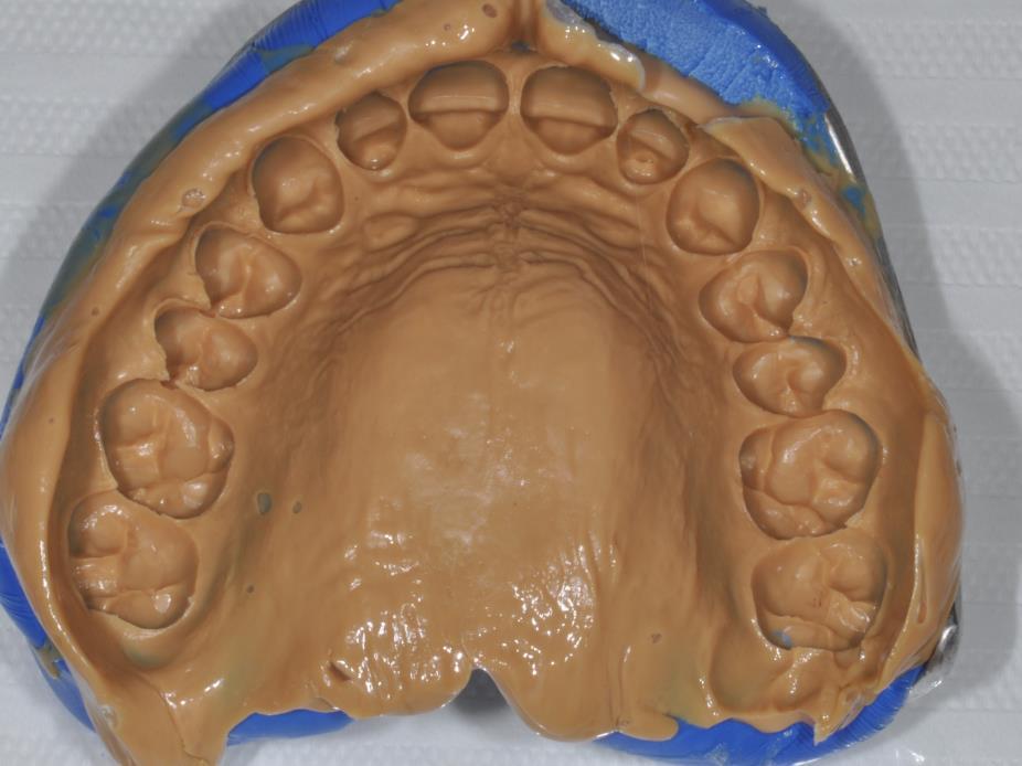 20 Figura 12- Moldagem de trabalho com silicone de adição - (Virtual- Ivoclar) Fonte: Arquivo pessoal de José Vitor Quinelli Mazaro Imediatamente após a moldagem foi realizada a seleção da cor com a